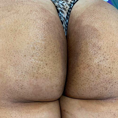 Foliculite ou Manchas no Bumbum